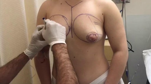 ⁣Tubular Breast Deformity (Pre-Operation)