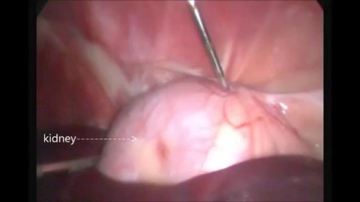 ⁣laparoscopic Renal biopsy