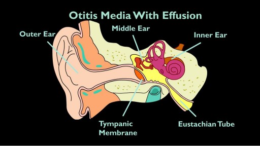 ⁣Otitis Media With Effusion