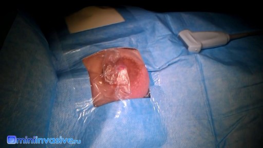 ⁣Acute purulent lactational mastitis surgery