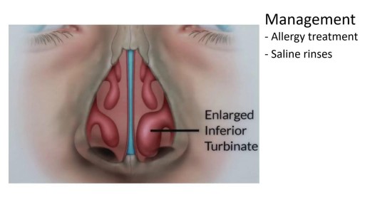 ⁣Enlarged Nasal Turbinates, Symptoms, and Treatment