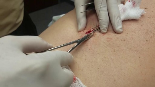 ⁣Surgical cutting and removal of a deep skin cyst