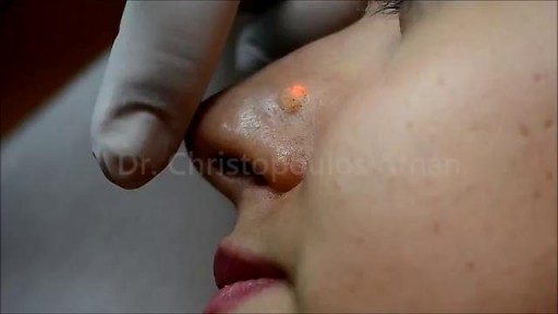 ⁣Nevus (mole) removal by LASER