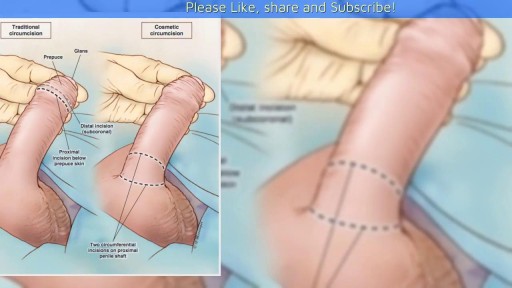 Penile Adhesions After Circumcision