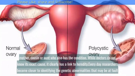 ⁣Causes of Polycystic Ovarian Syndrome