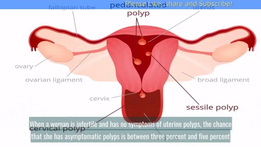 ⁣What Are the Symptoms of Uterine Polyps?