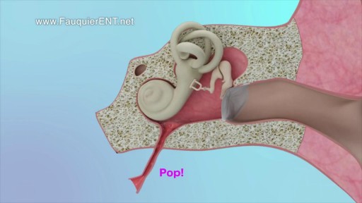 ⁣Clogged Ear Due to Ear Infection or Eustachian Tube Dysfunction