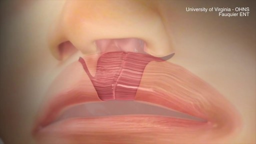 ⁣Cleft Lip Repair animation