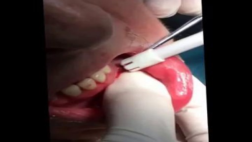 ⁣Dental Abscess Drainage and Extraction