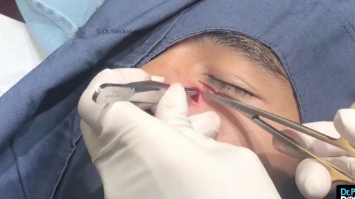 ⁣Nose Cyst Extraction