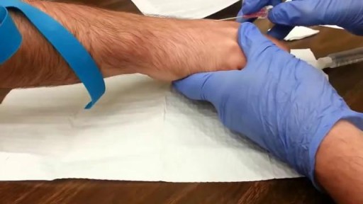 ⁣How to start an IV: Dorsum of hand