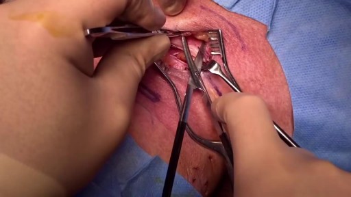 ⁣Surgical tracheostomy