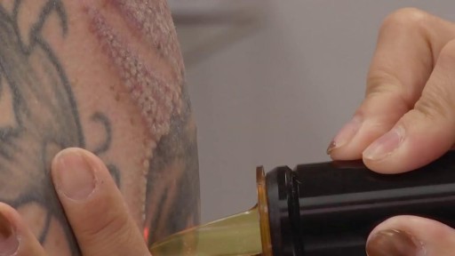 ⁣Laser Tattoo Removal Procedure