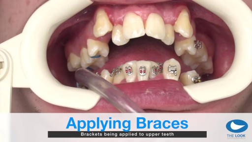 ⁣How teeth braces are put