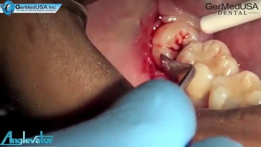 ⁣Impacted Tooth 32 Extraction