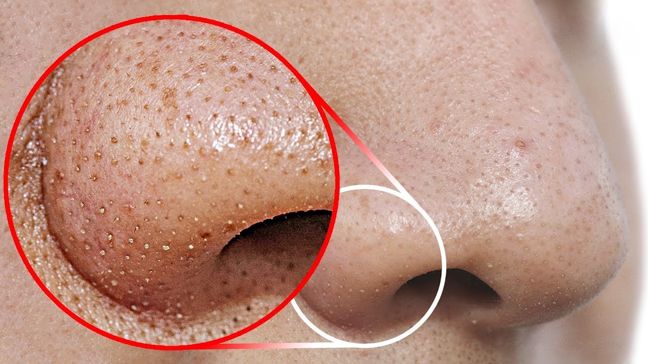 ⁣How to Get Rid of Blackheads From Your Nose