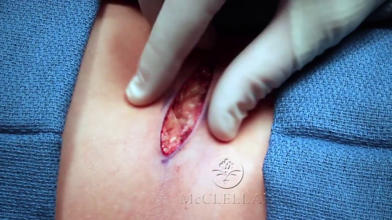 ⁣How to Perform Invisible Skin Sutures Technique