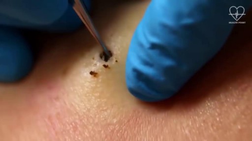 ⁣Amazing Removal of Giant 15 Years Old Blackhead From Skin