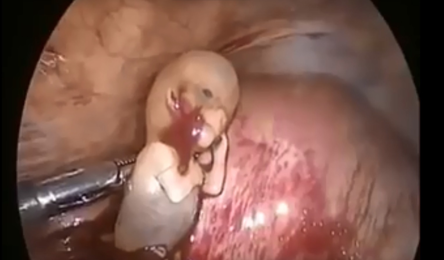 ⁣Ectopic Baby Removal Surgery