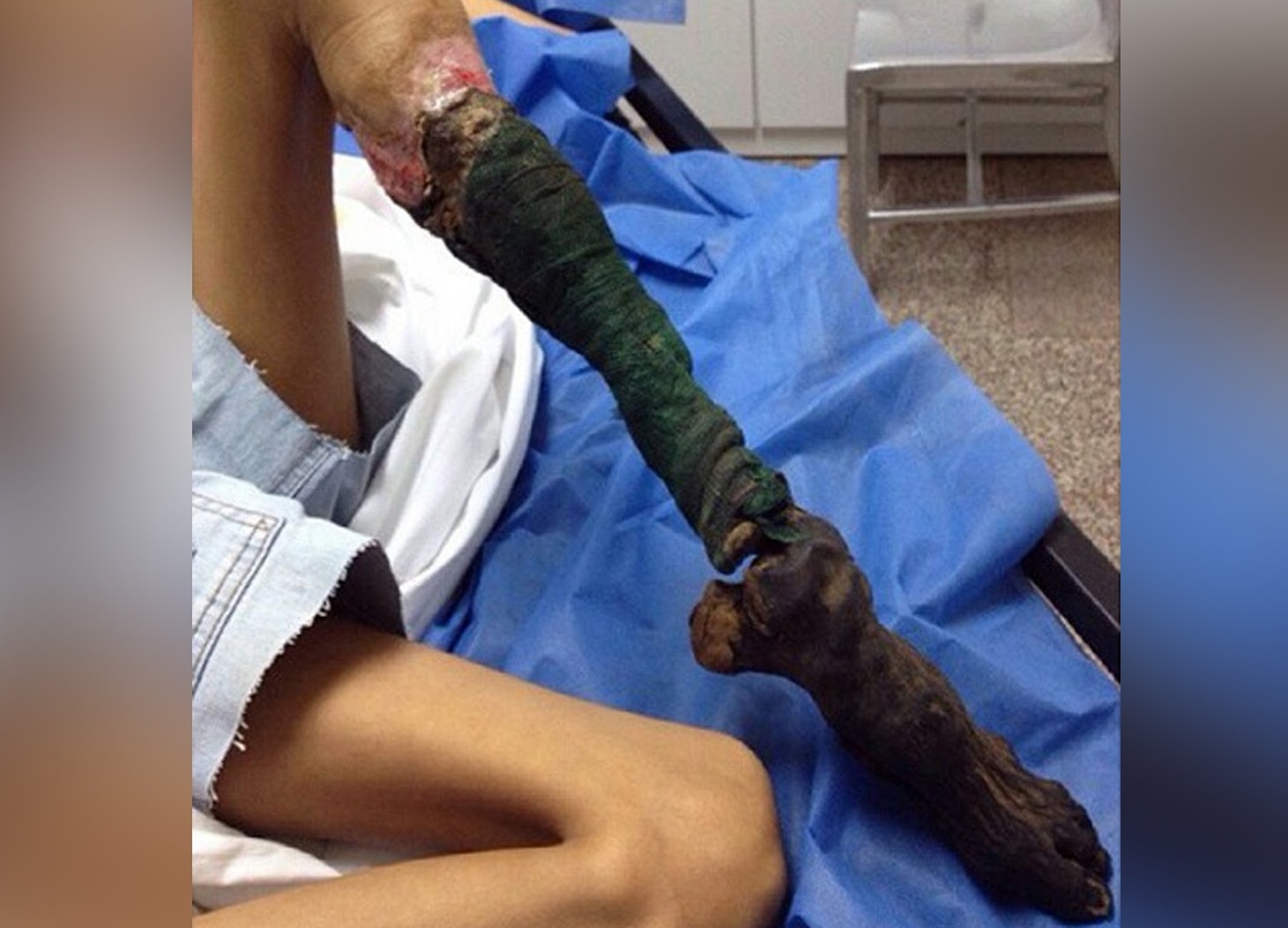 ⁣Snake bite caused girl’s leg to rot away