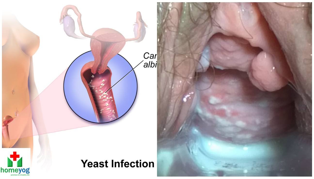 ⁣Female Genital Infections Causes and treatments.