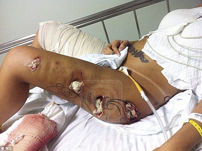 ⁣Model's Leg and Butt Cosmetic Implants Exploded Inside Her