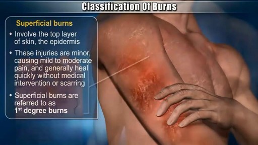 ⁣Burns EMERGENCY MANAGEMENT