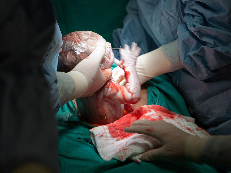 Cesarean Delivery Live - Baby delivery Surgery