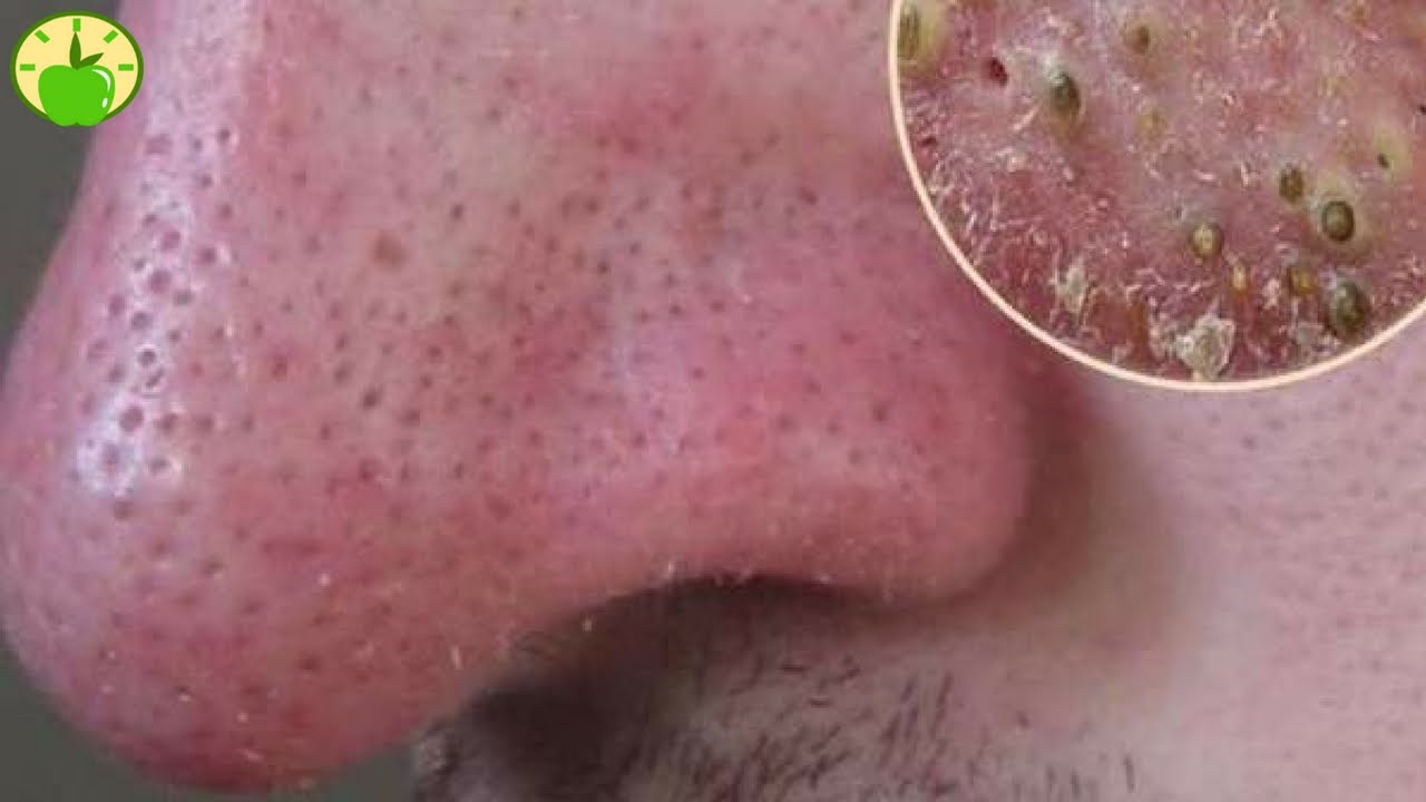 ⁣How to Get Rid of Blackheads on Your Nose Naturally