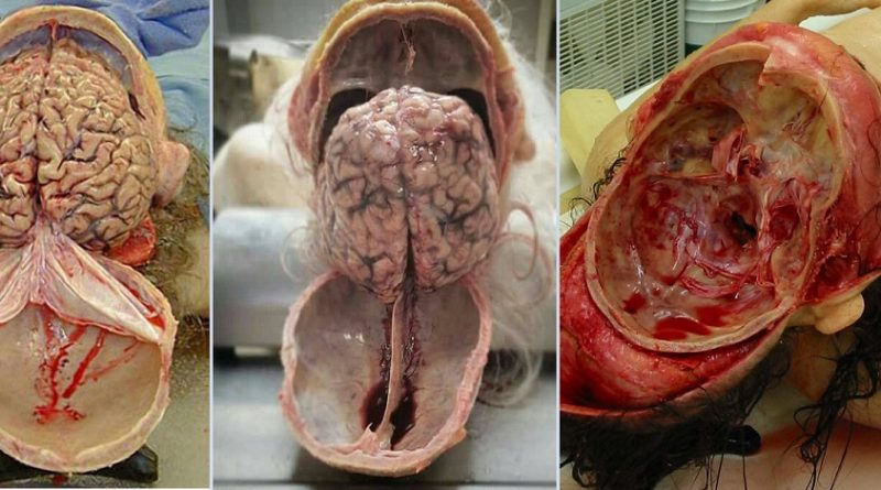 Anatomy Videos - Human Brain Removal During Autopsy