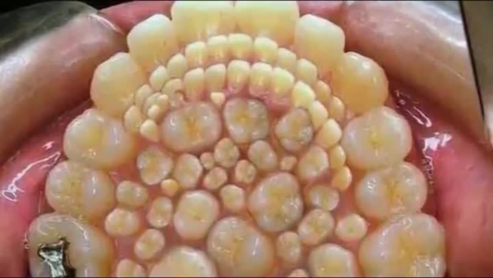 ⁣232 Teeth Removal From Indians' Boy Mouth