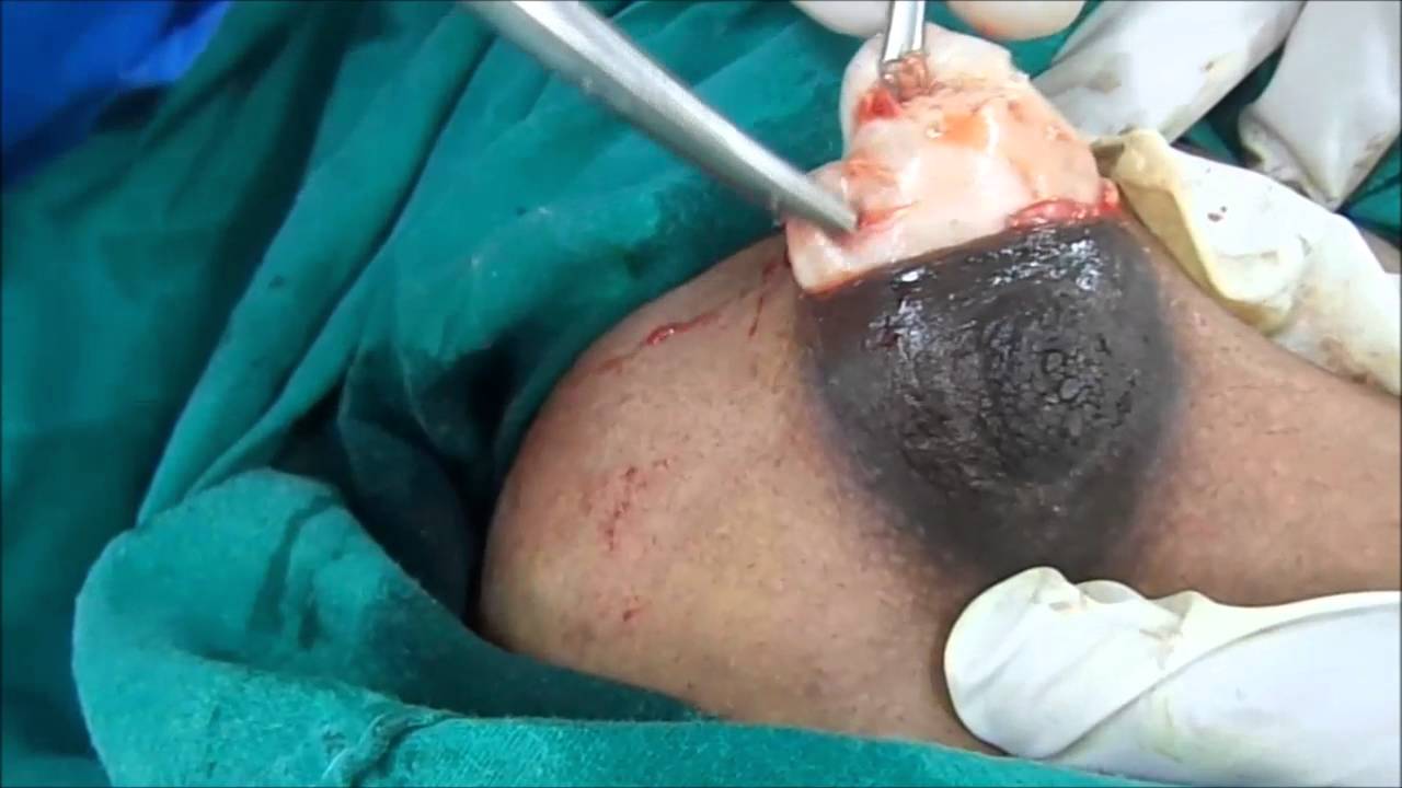⁣A Big Size Fibrodenoma Removal Under Local Anesthesia