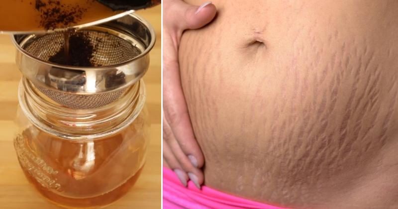 How to Get Rid of Stretch Marks Fast - Get Rid of Stretch Marks Naturally