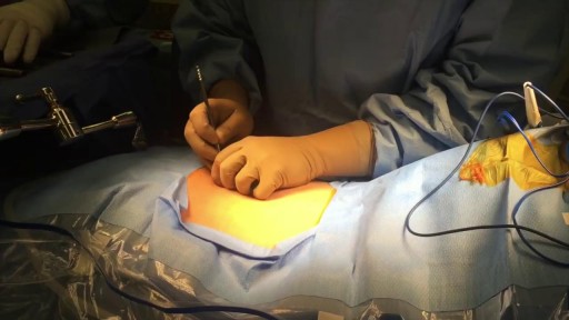 ⁣Minimally Invasive Microdiscectomy L5-S1
