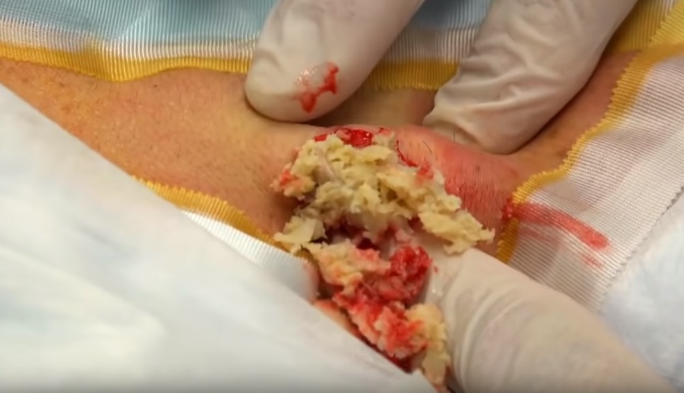 ⁣Popping Huge Epidermoid Cyst