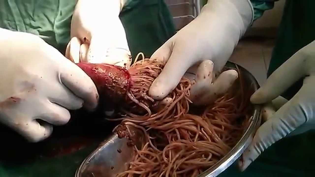 Bodybuilder's Colon Contains 10 lbs of Meat Worms