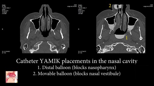 ⁣Nasal catheter YAMIK