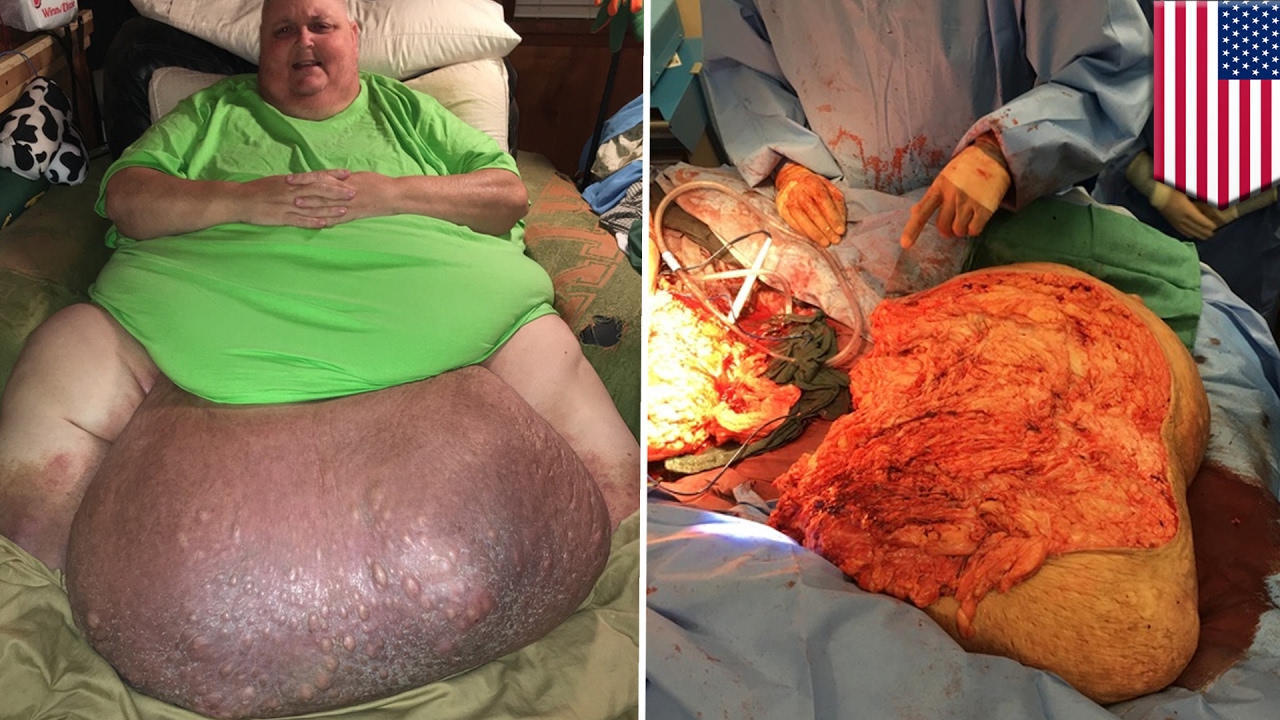 Ingrown hair turned into 140-pound tumor in man’s stomach