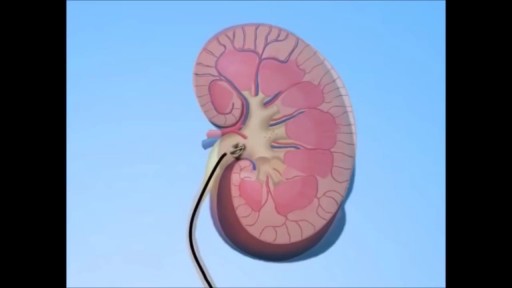 Kidney Stone Treatment - UreteroScopy