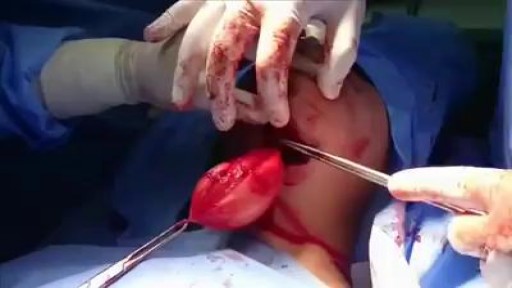 ⁣Removal of large epidermoid cyst from floor of the mouth