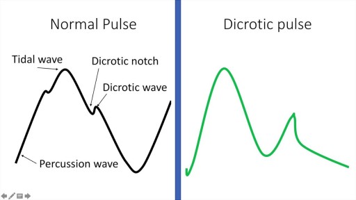 Arterial Pulse in health and disease