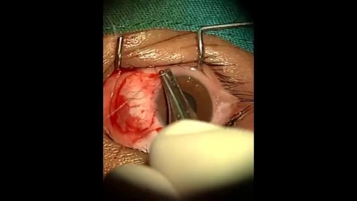 ⁣Pterygium Surgery