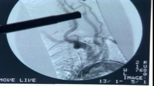 Carotid Endarterectomy Procedure