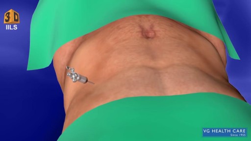 3D Laparoscopic Appendectomy Surgery