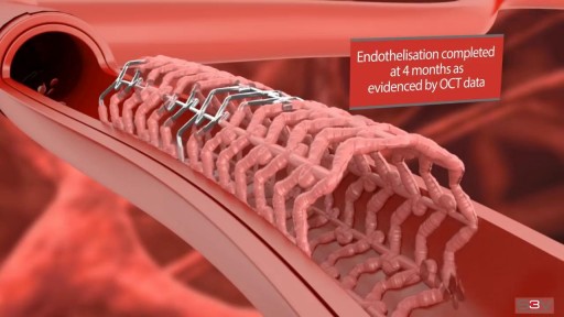 ⁣Heart Stent and Angioplasty - 3D Medical Video Animation