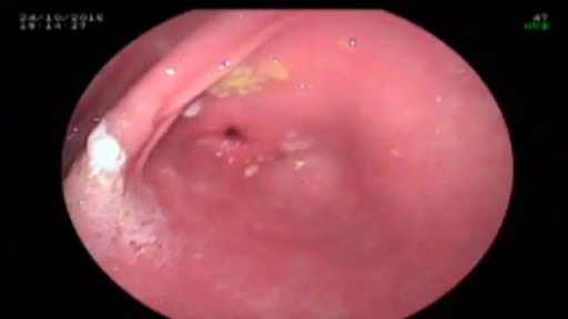 ⁣Esophageal tear with ulcer