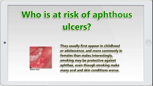 ⁣Aphthous ulcers
