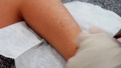 Birthmark Removal with Laser