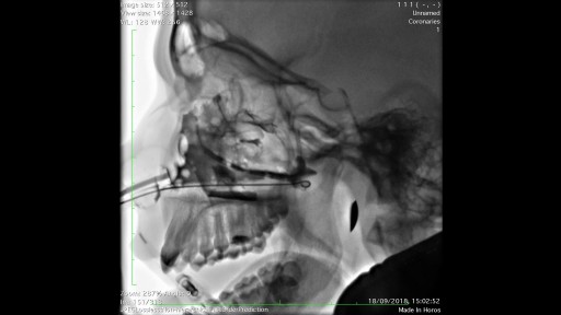 X ray paranasal sinuses.Yamik procedure