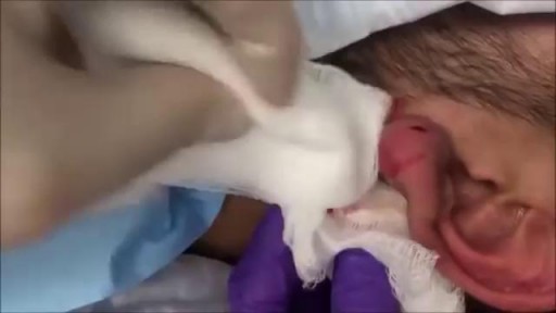 Popping Cyst in the Ear Lobe